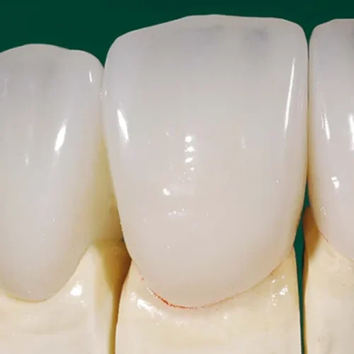 emax-dis-kaplama-nedir-1024x536