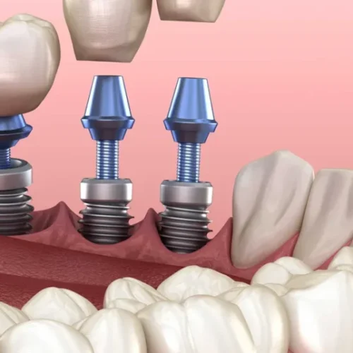 implant-tedavisi-1024x536