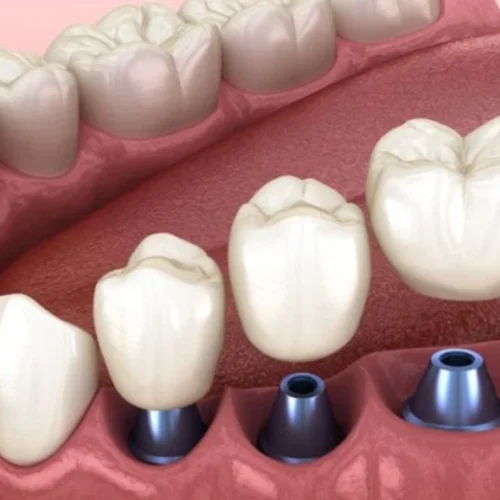 kron-dis-kaplama-nedir-1024x536