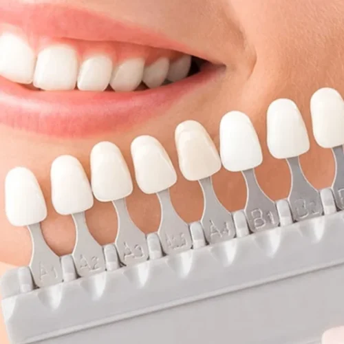 lamine-dis-laplama-nedir-1024x536